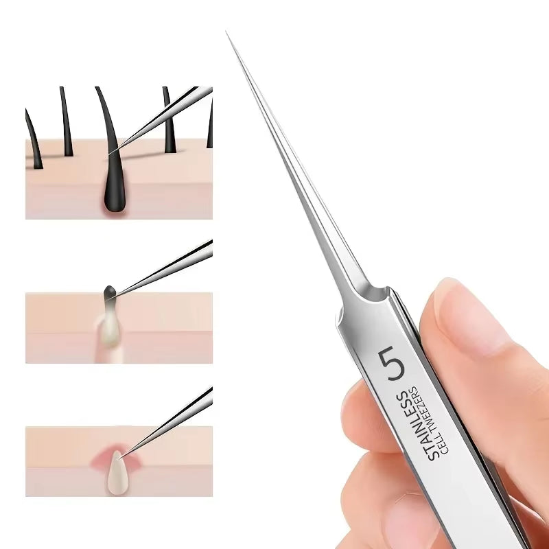 Ultra fine Acne Tweezers – Extra Fine Blackhead, Acne, and Blemish Removal Tool - VOLARA Supply