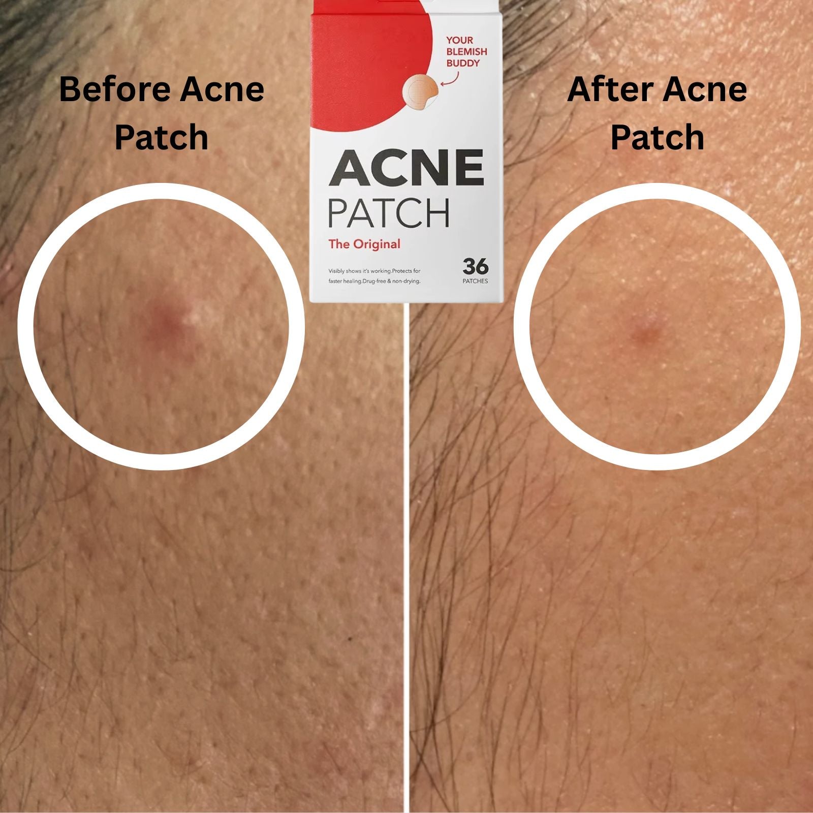 Acne Patch – Invisible, Waterproof & Fast-Healing Hydrocolloid Patches for Clear Skin - VOLARA Supply